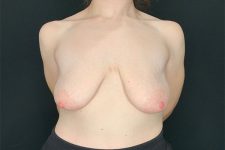 before breast lift front view female patient case 1858