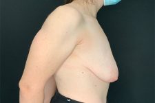 before breast lift right side view female patient case 1858