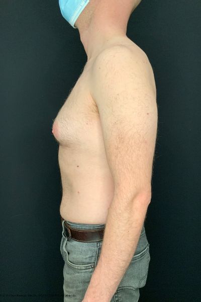 before male breast reduction gynecomastia left side view male patient case 1817