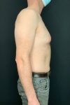 before male breast reduction gynecomastia right side view male patient case 1817