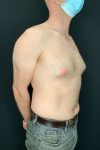 before male breast reduction gynecomastia right angle view male patient case 1817