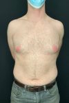 before male breast reduction gynecomastia front view male patient case 1817