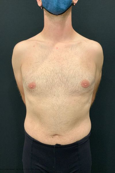 after male breast reduction gynecomastia front view male patient case 1817