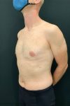 after male breast reduction gynecomastia left angle view male patient case 1817