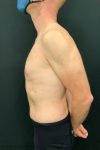 after male breast reduction gynecomastia left side view male patient case 1817