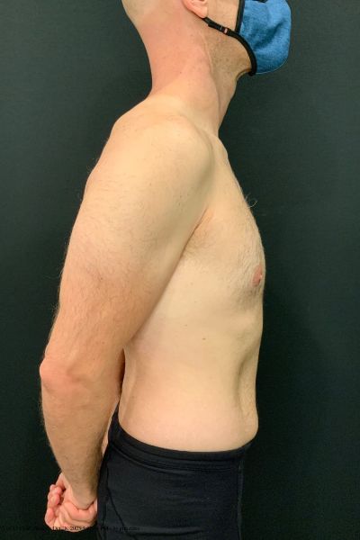 after male breast reduction gynecomastia right side view male patient case 1817