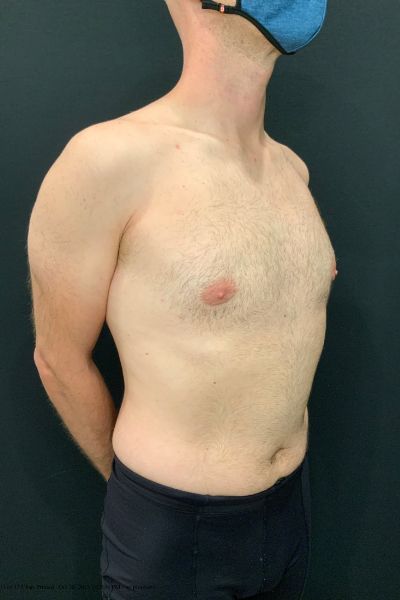 after male breast reduction gynecomastia right angle view male patient case 1817