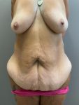before mommy makeover front view female patient case 1840