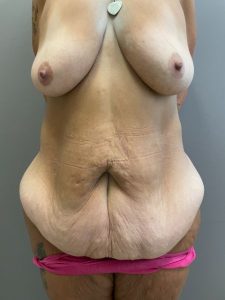 before mommy makeover front view female patient case 1840