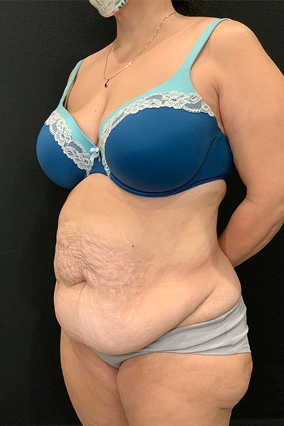 before tummy tuck left angle view female patient case 1801