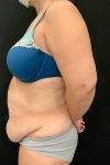 before tummy tuck left side view female patient case 1801