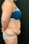 before tummy tuck right side view female patient case 1801