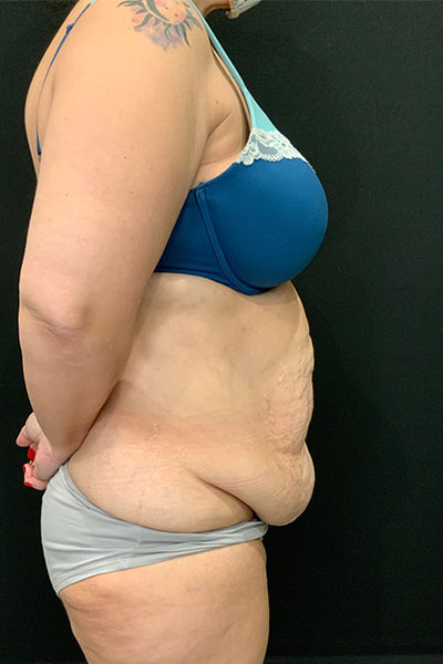 before tummy tuck right side view female patient case 1801